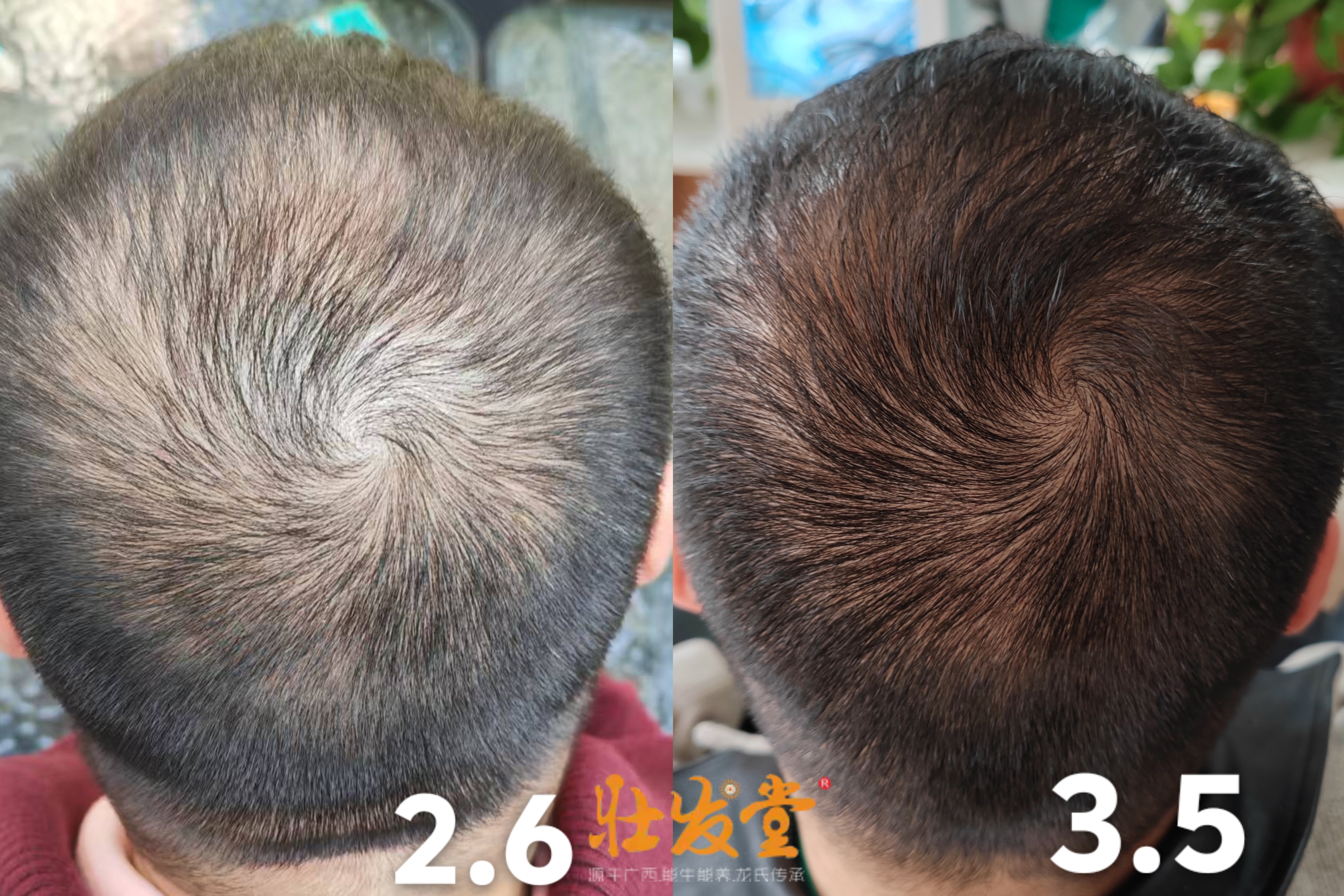 脱养密一个月效果